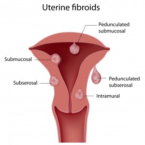 uterine fibroid showing submucosal, subserosal and intramural fibroids