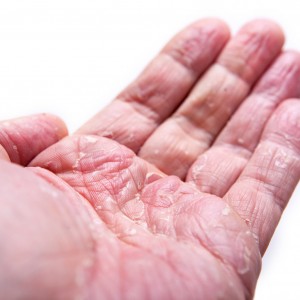 picture of eczema psoriasis or dermatitis on skin of hand
