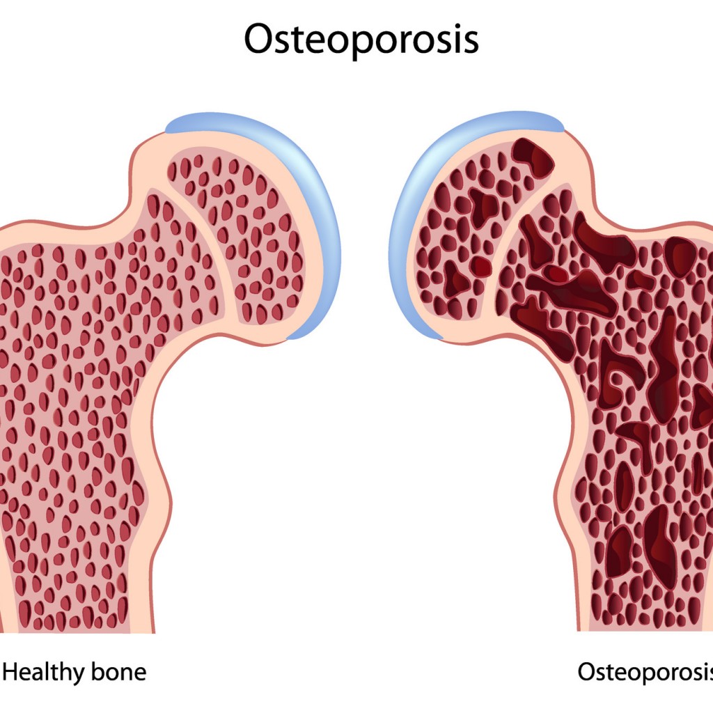 Natural Treatment For Osteoporosis Or Osteopenia